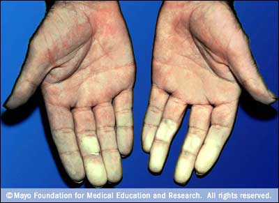 raynaud.jpg